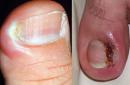 Нарыв на пальце возле ногтя — лечение и профилактика, частые причины нарывов