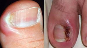An abscess on a finger near the nail - treatment and prevention, common causes of abscesses