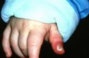 Нарывает палец на руке: причины, симптомы и метод лечения