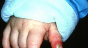Sore finger on hand: causes, symptoms and treatment